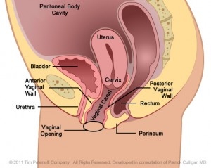 VSUI Uterus Prolapse Stage 2