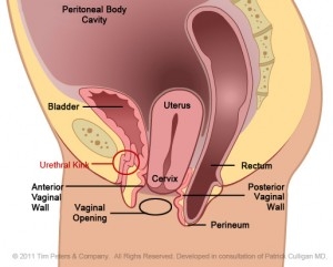 VSUI - Uterus Prolapse Stage 3