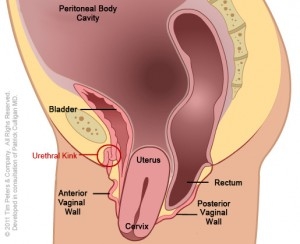VSUI - Uterus Prolapse Stage 4