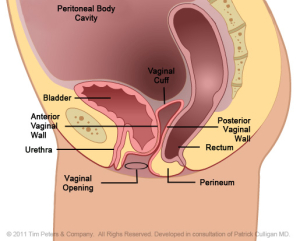 Cystocele - no uterus - stage 2