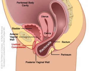 Rectocele-With-Uterus-Image-4-300x240