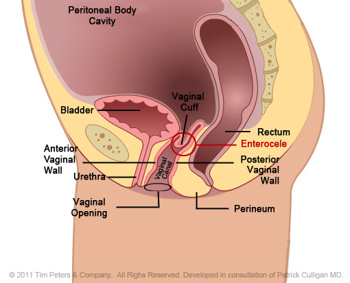 Dr. Veronikis - Dr. Wood - Vaginal Vault Prolapse P2 - St. Louis