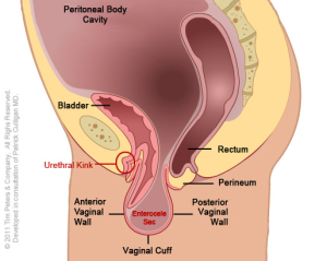 Dr. Veronikis - Dr. Wood - Vaginal Vault Prolapse P4 - St. Louis