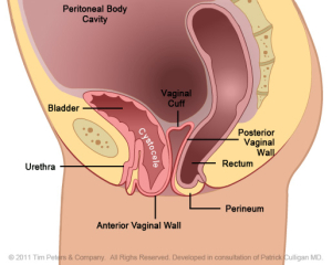 Cystocele-No-Uterus---Image-3