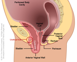 Cystocele-No-Uterus---Image-4