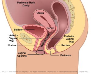 Rectocele with uterus - Dr. Veronikis - Dr. Wood - St. Louis